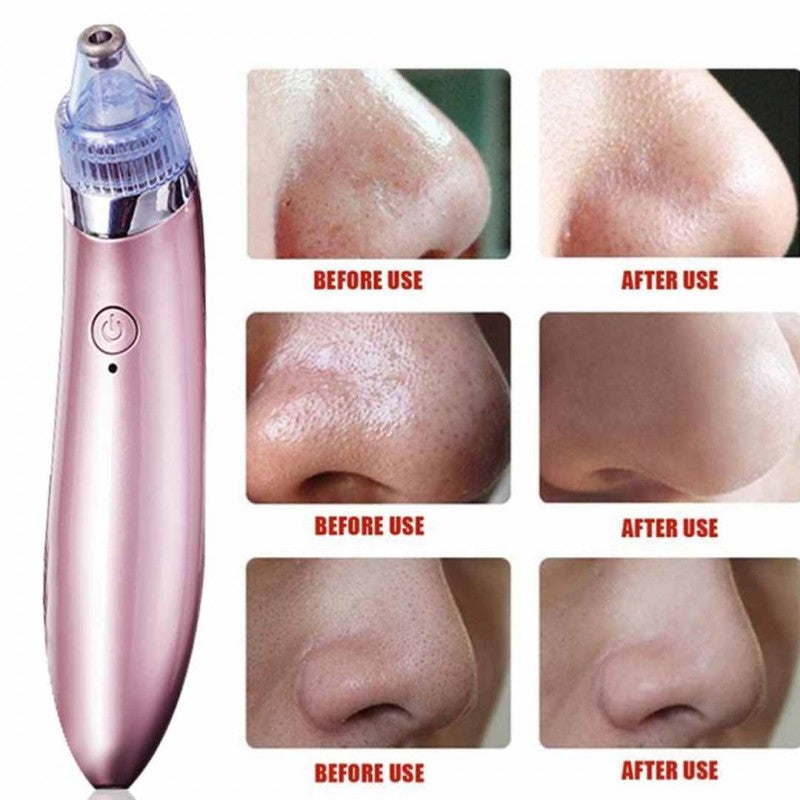 Blackhead Remover | 5 مستويات شفط، مزيل رؤوس سوداء قابل لإعادة الشحن عبر USB