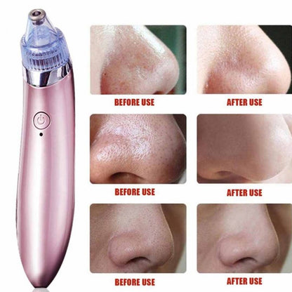 Blackhead Remover | 5 مستويات شفط، مزيل رؤوس سوداء قابل لإعادة الشحن عبر USB