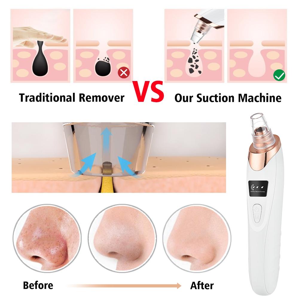 Blackhead Remover | 5 مستويات شفط، مزيل رؤوس سوداء قابل لإعادة الشحن عبر USB