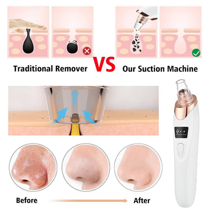 Blackhead Remover | 5 مستويات شفط، مزيل رؤوس سوداء قابل لإعادة الشحن عبر USB